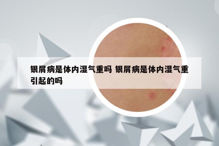 银屑病是体内湿气重吗 银屑病是体内湿气重引起的吗