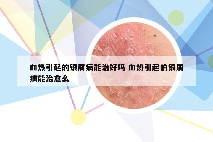 血热引起的银屑病能治好吗 血热引起的银屑病能治愈么