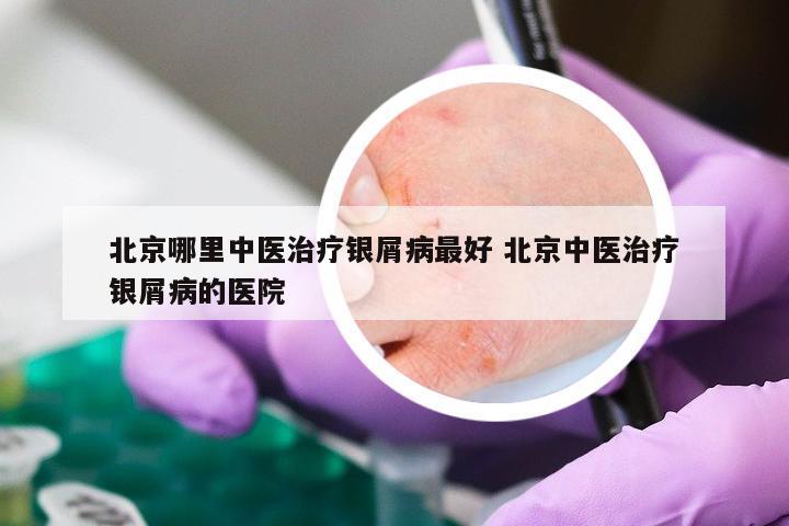 北京哪里中医治疗银屑病最好 北京中医治疗银屑病的医院