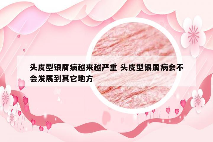 头皮型银屑病越来越严重 头皮型银屑病会不会发展到其它地方