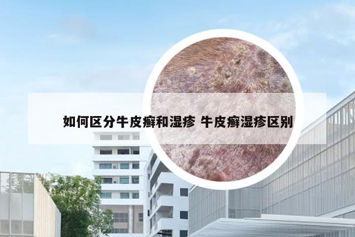 如何区分牛皮癣和湿疹 牛皮癣湿疹区别