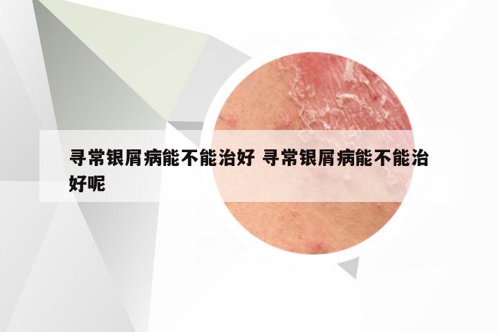 寻常银屑病能不能治好 寻常银屑病能不能治好呢