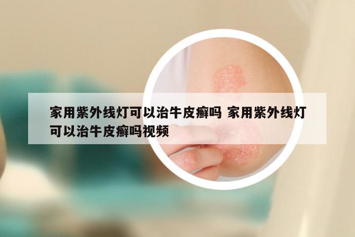 家用紫外线灯可以治牛皮癣吗 家用紫外线灯可以治牛皮癣吗视频
