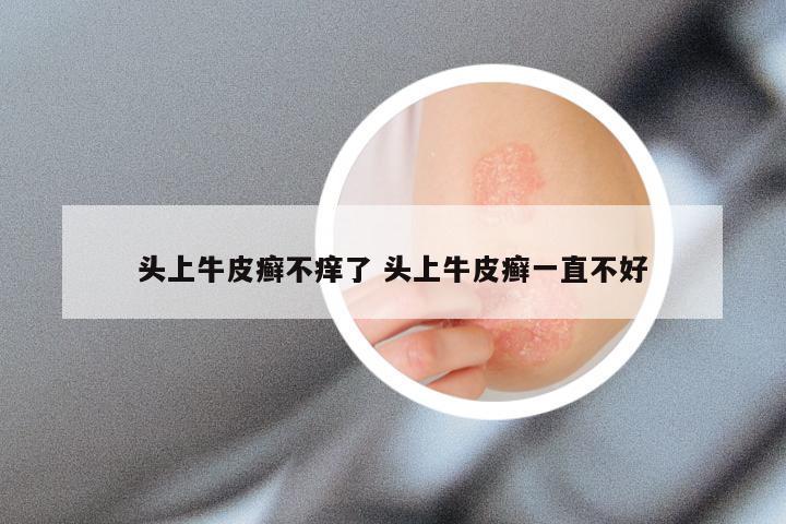 头上牛皮癣不痒了 头上牛皮癣一直不好
