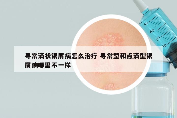 寻常滴状银屑病怎么治疗 寻常型和点滴型银屑病哪里不一样