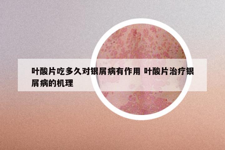 叶酸片吃多久对银屑病有作用 叶酸片治疗银屑病的机理