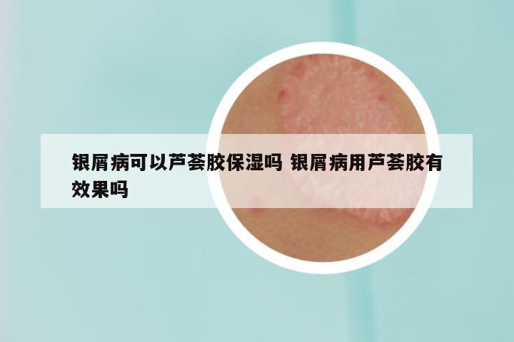 银屑病可以芦荟胶保湿吗 银屑病用芦荟胶有效果吗