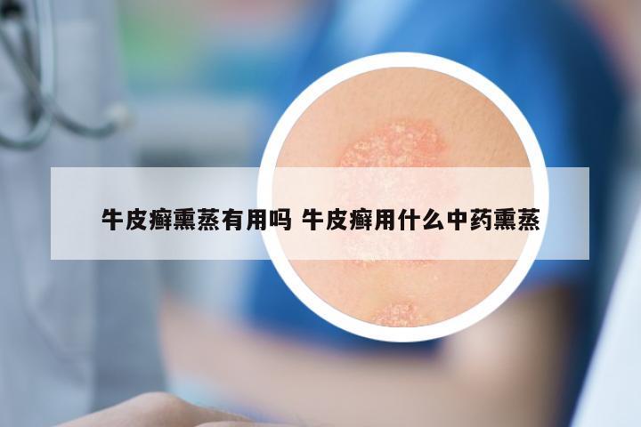 牛皮癣熏蒸有用吗 牛皮癣用什么中药熏蒸