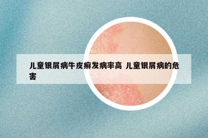 儿童银屑病牛皮癣发病率高 儿童银屑病的危害