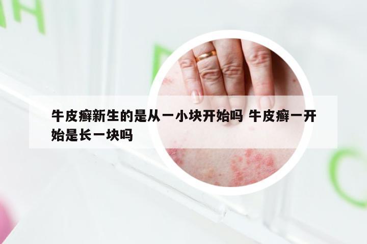 牛皮癣新生的是从一小块开始吗 牛皮癣一开始是长一块吗