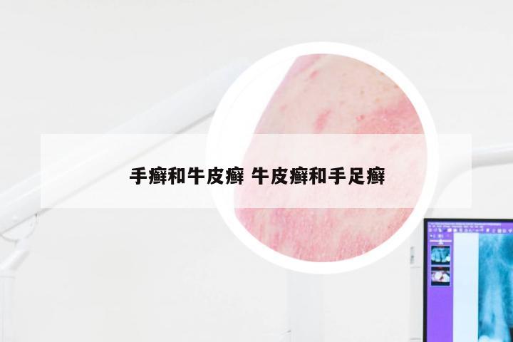 手癣和牛皮癣 牛皮癣和手足癣