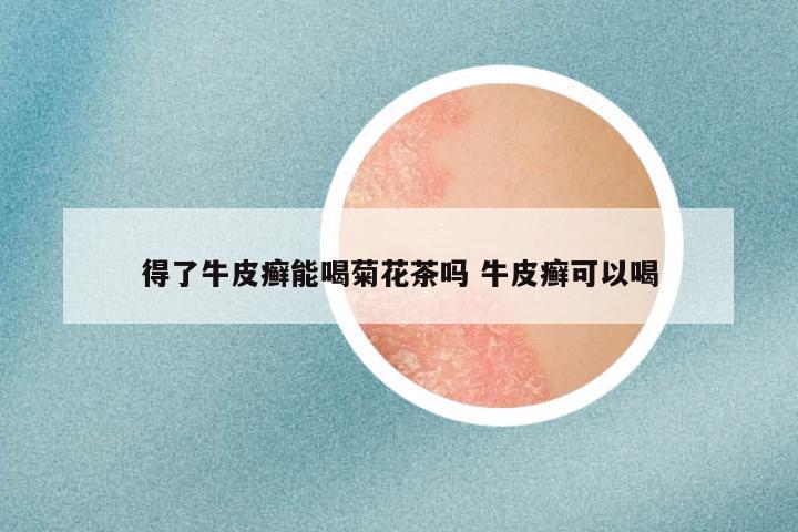 得了牛皮癣能喝菊花茶吗 牛皮癣可以喝