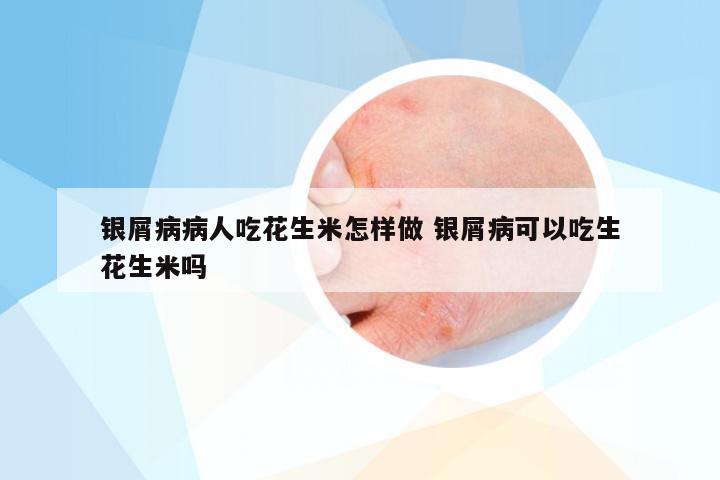 银屑病病人吃花生米怎样做 银屑病可以吃生花生米吗