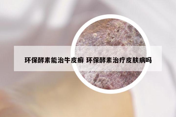 环保酵素能治牛皮癣 环保酵素治疗皮肤病吗