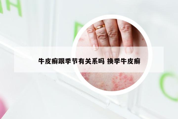 牛皮癣跟季节有关系吗 换季牛皮癣