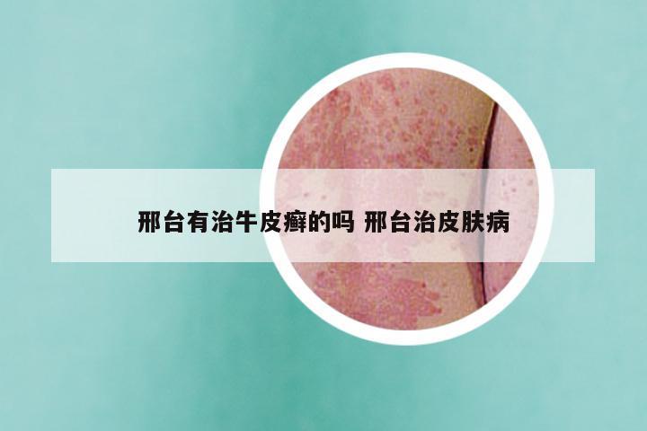 邢台有治牛皮癣的吗 邢台治皮肤病