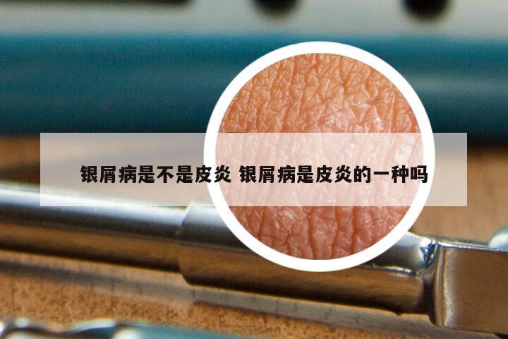 银屑病是不是皮炎 银屑病是皮炎的一种吗