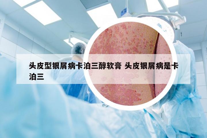 头皮型银屑病卡泊三醇软膏 头皮银屑病是卡泊三