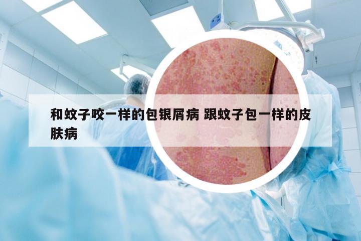 和蚊子咬一样的包银屑病 跟蚊子包一样的皮肤病