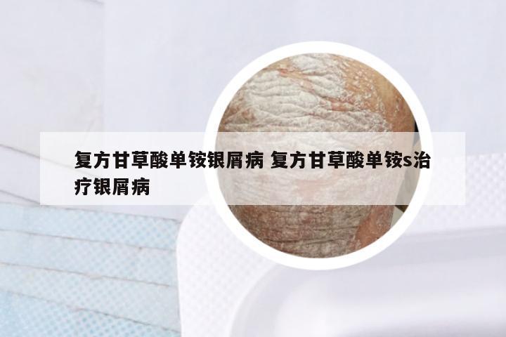 复方甘草酸单铵银屑病 复方甘草酸单铵s治疗银屑病