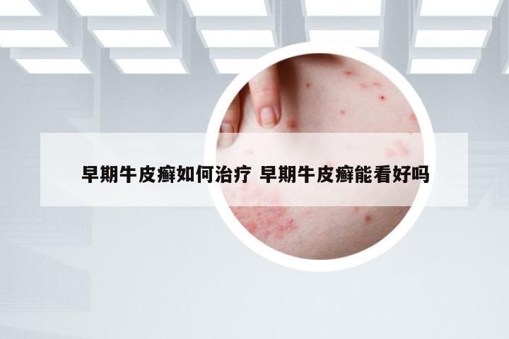 早期牛皮癣如何治疗 早期牛皮癣能看好吗