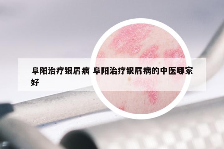 阜阳治疗银屑病 阜阳治疗银屑病的中医哪家好