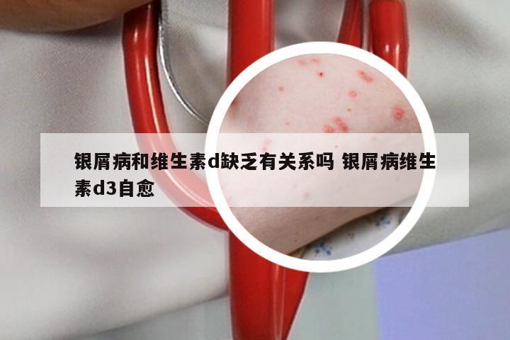 银屑病和维生素d缺乏有关系吗 银屑病维生素d3自愈