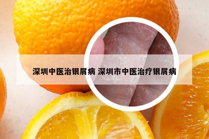 深圳中医治银屑病 深圳市中医治疗银屑病