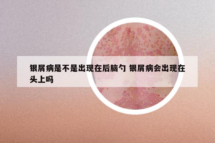 银屑病是不是出现在后脑勺 银屑病会出现在头上吗