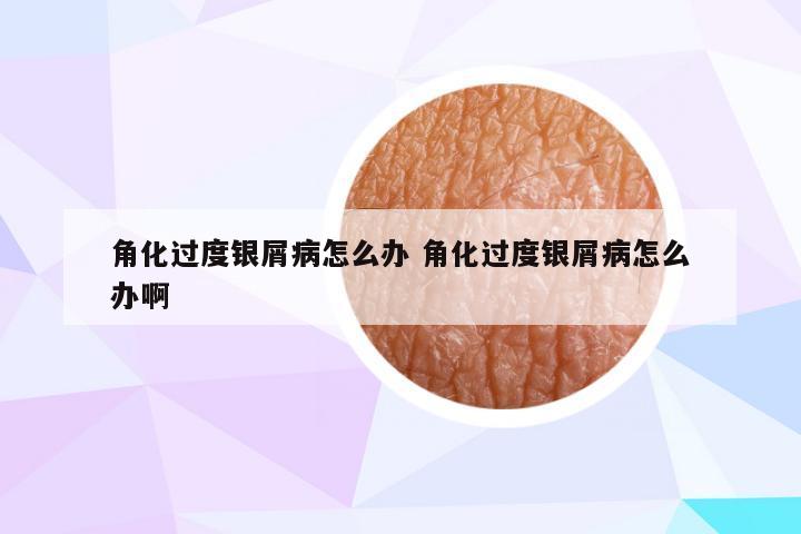 角化过度银屑病怎么办 角化过度银屑病怎么办啊