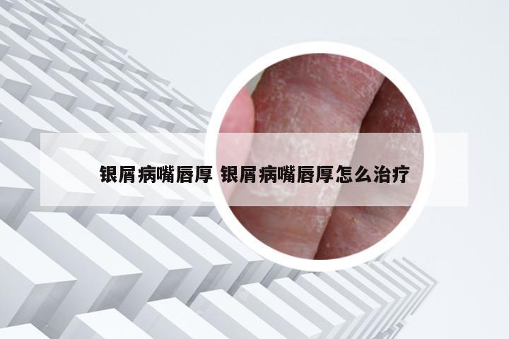 银屑病嘴唇厚 银屑病嘴唇厚怎么治疗