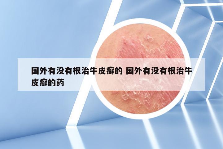 国外有没有根治牛皮癣的 国外有没有根治牛皮癣的药