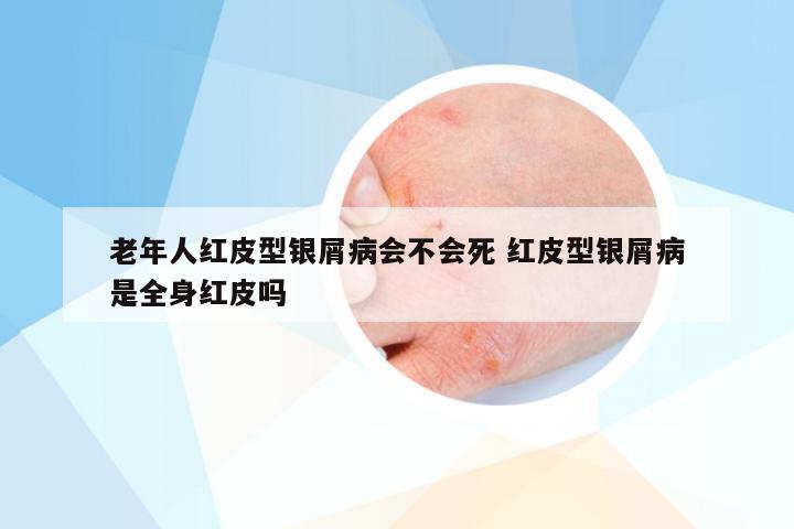 老年人红皮型银屑病会不会死 红皮型银屑病是全身红皮吗