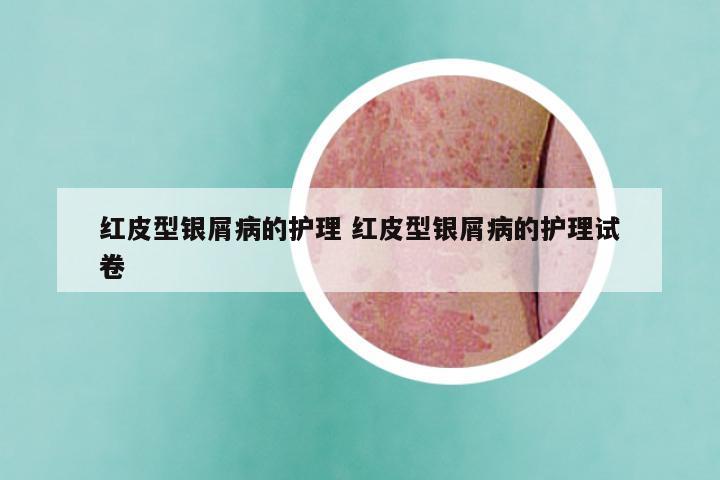 红皮型银屑病的护理 红皮型银屑病的护理试卷