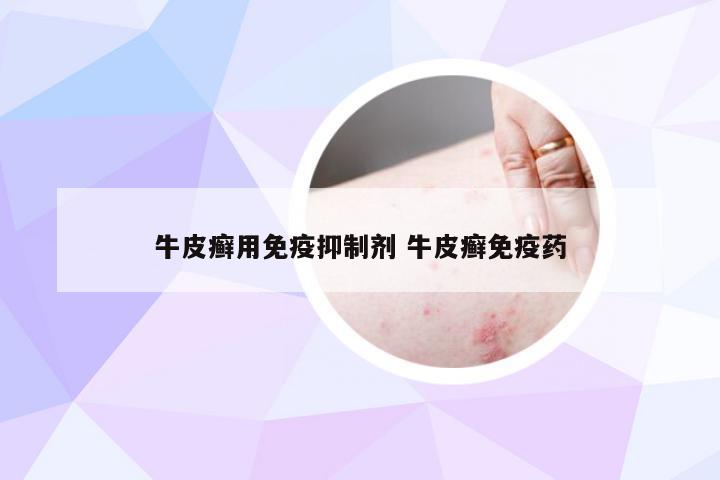 牛皮癣用免疫抑制剂 牛皮癣免疫药