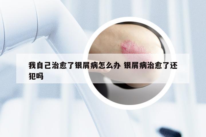 我自己治愈了银屑病怎么办 银屑病治愈了还犯吗