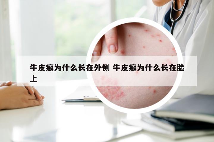 牛皮癣为什么长在外侧 牛皮癣为什么长在脸上