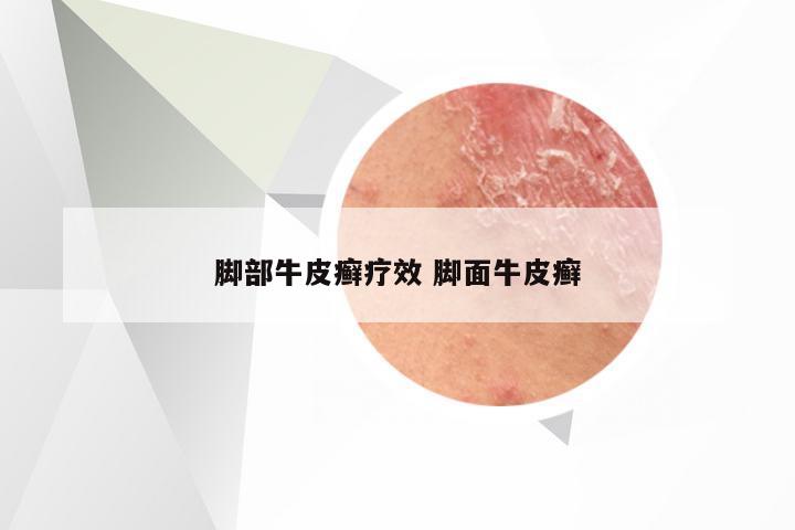 脚部牛皮癣疗效 脚面牛皮癣