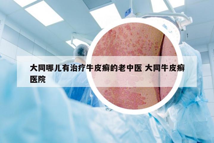 大同哪儿有治疗牛皮癣的老中医 大同牛皮癣医院