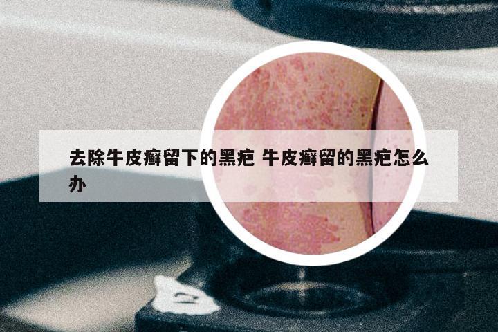 去除牛皮癣留下的黑疤 牛皮癣留的黑疤怎么办