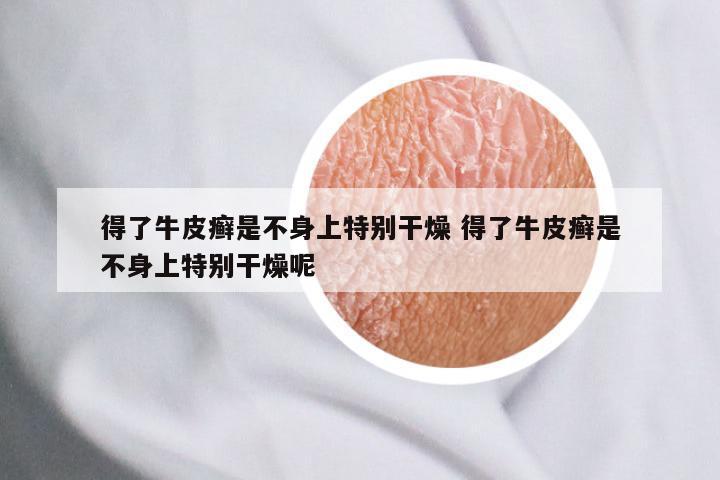 得了牛皮癣是不身上特别干燥 得了牛皮癣是不身上特别干燥呢