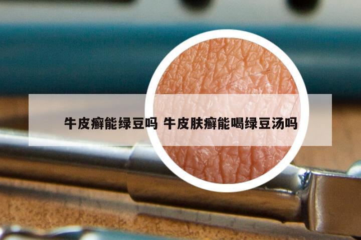 牛皮癣能绿豆吗 牛皮肤癣能喝绿豆汤吗