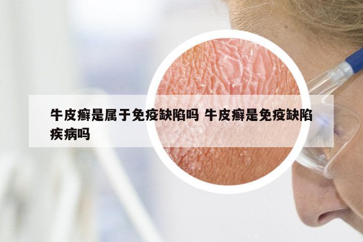 牛皮癣是属于免疫缺陷吗 牛皮癣是免疫缺陷疾病吗