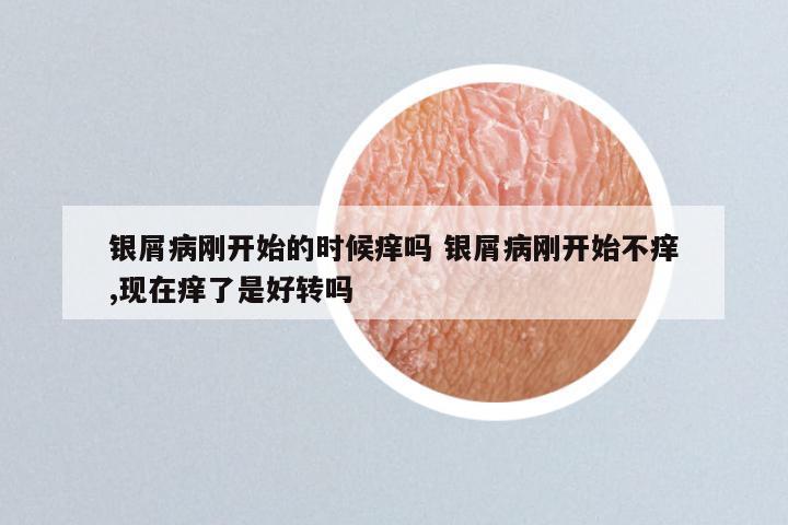 银屑病刚开始的时候痒吗 银屑病刚开始不痒,现在痒了是好转吗