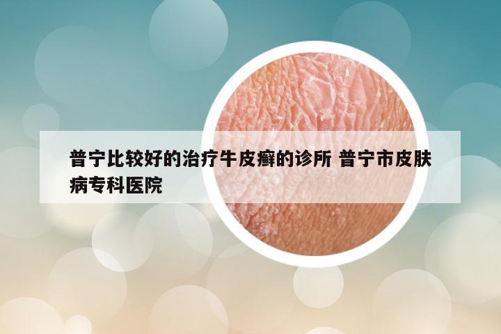 普宁比较好的治疗牛皮癣的诊所 普宁市皮肤病专科医院