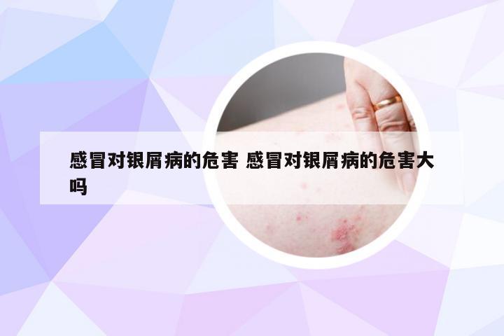感冒对银屑病的危害 感冒对银屑病的危害大吗