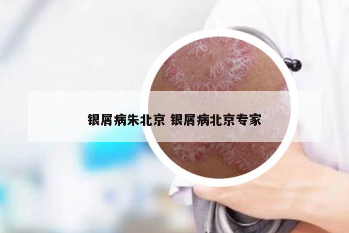 银屑病朱北京 银屑病北京专家