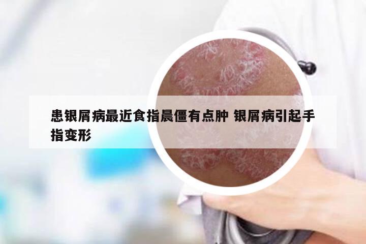 患银屑病最近食指晨僵有点肿 银屑病引起手指变形
