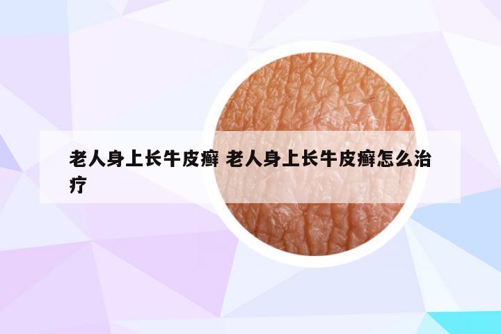 老人身上长牛皮癣 老人身上长牛皮癣怎么治疗