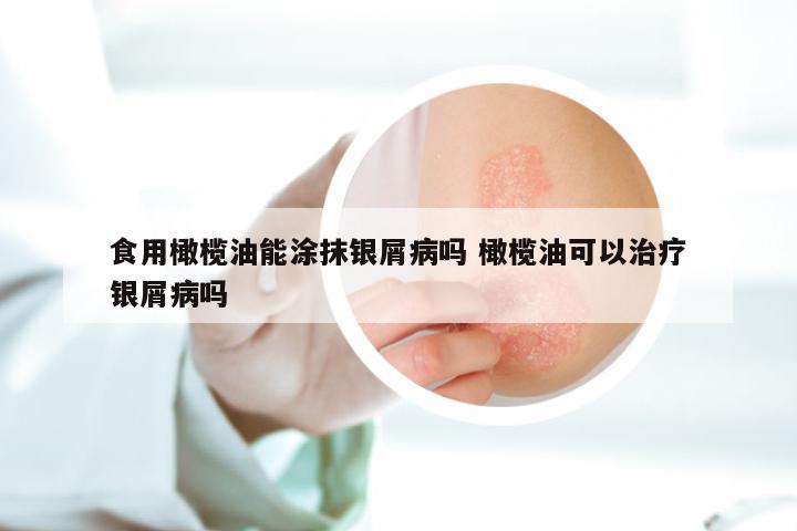 食用橄榄油能涂抹银屑病吗 橄榄油可以治疗银屑病吗